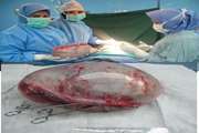 خارج کردن توده ای به ابعاد 35 در 25 سانتیمتر از شکم دختربچه ده ساله در مرکز طبی کودکان